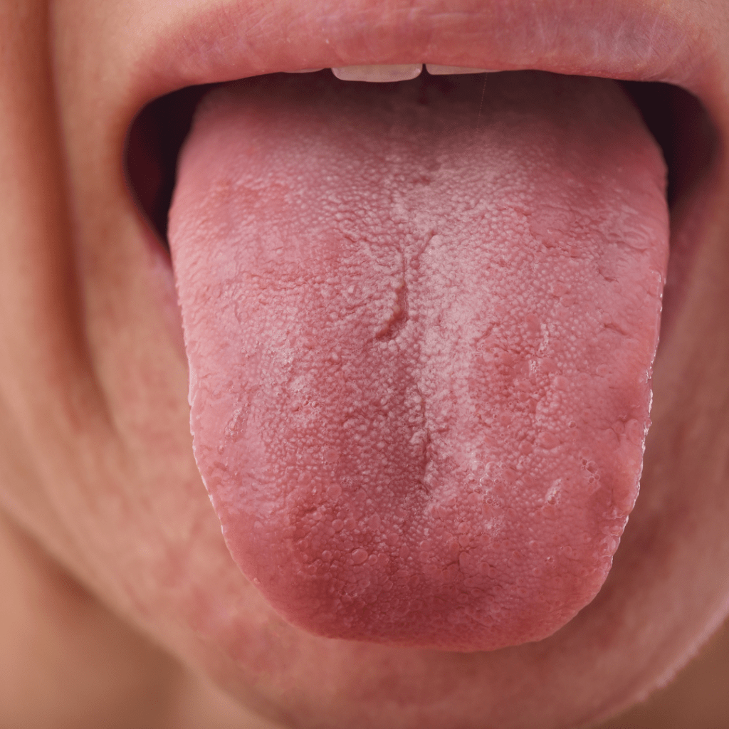 Tongue Health
